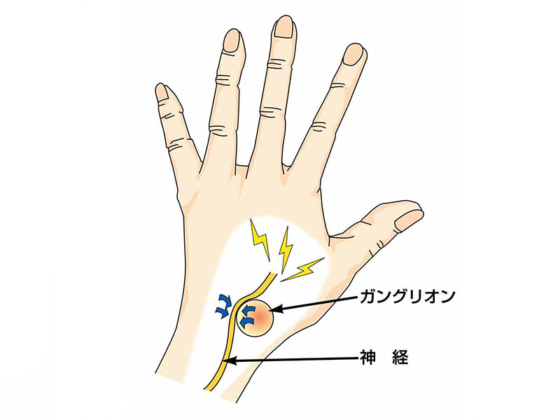 ガングリオン