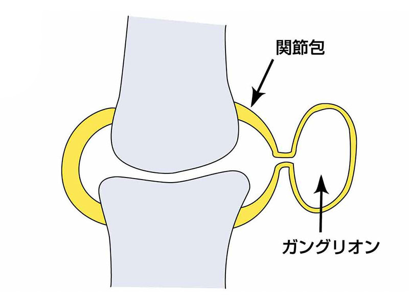 ガングリオン