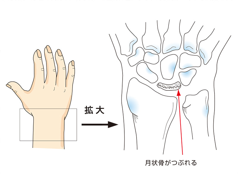 キーンベック病（月状骨軟化症）