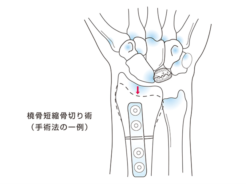 キーンベック病（月状骨軟化症）