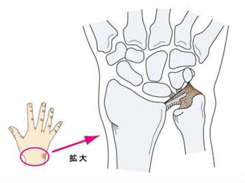 TFCC （三角繊維軟骨複合体）損傷