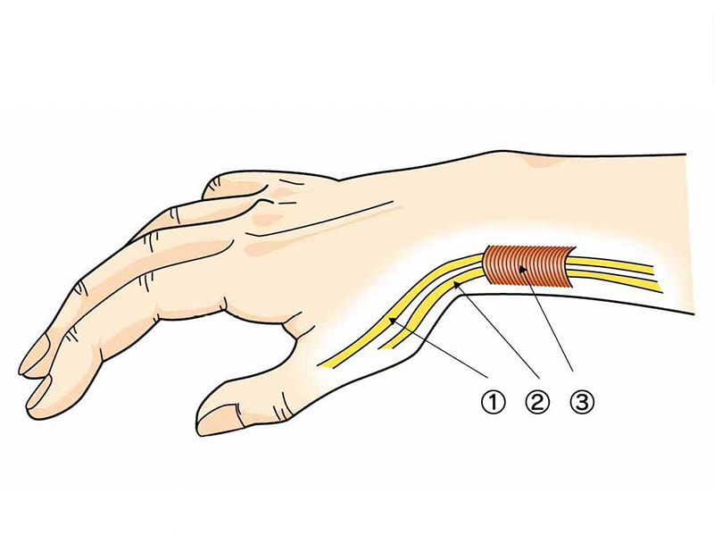 ドケルバン病（狭窄性腱鞘炎）