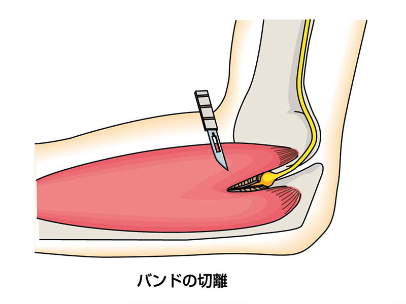 肘部管症候群