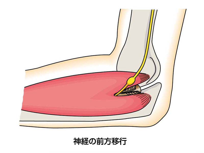 肘部管症候群