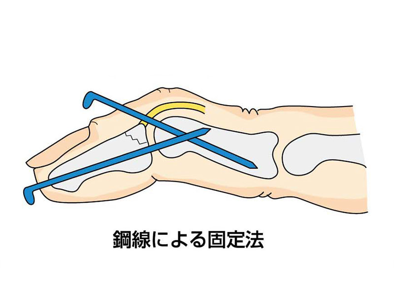 マレット変形（槌指）