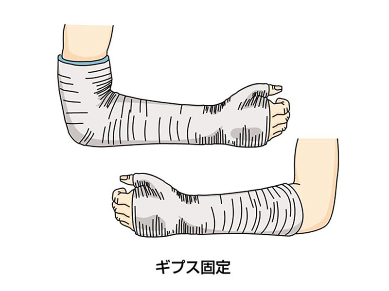 舟状骨骨折