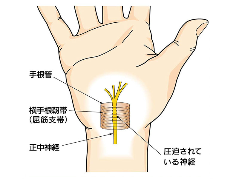 手根管症候群