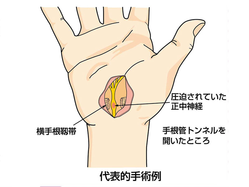 手根管症候群