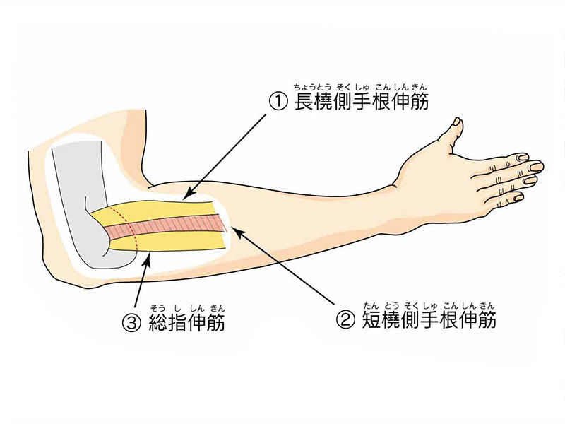 テニス肘(上腕骨外側上顆炎)