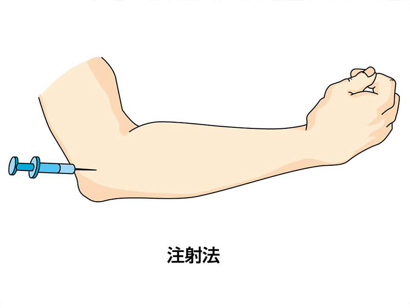 テニス肘（上腕骨外側上顆炎）