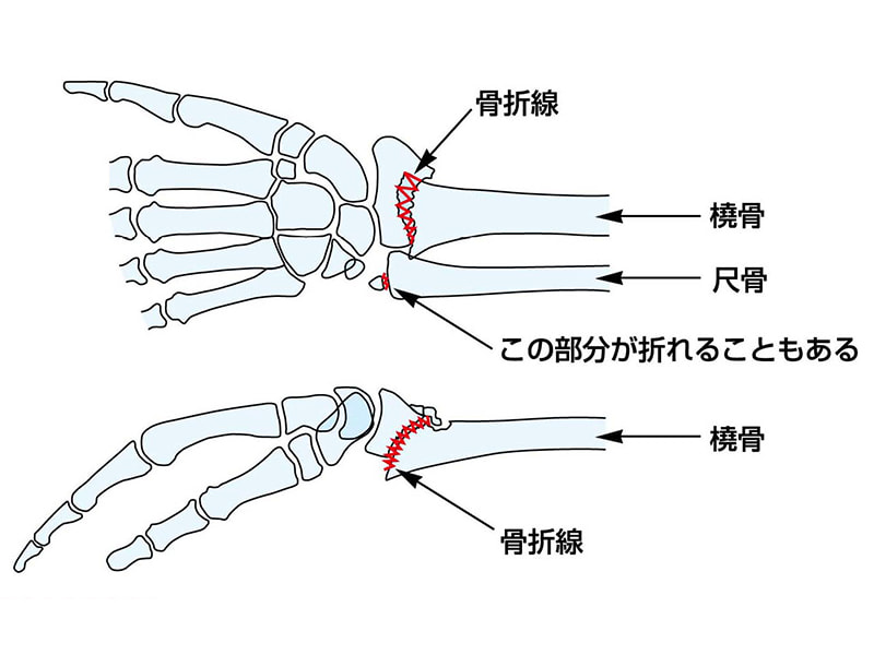 橈骨遠位端骨折