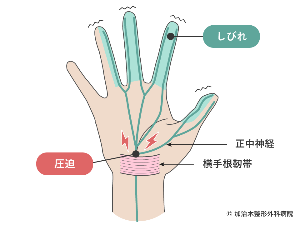 手根管症候群